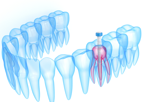 Root Canals