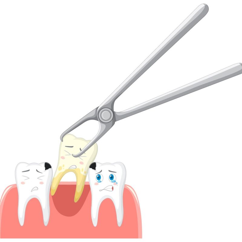 Tooth Extraction