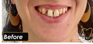 Smile Makeover