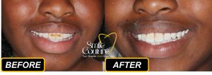 Fluorosis, Stains & Whitening