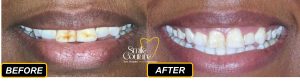 Fluorosis, Stains and Whitening