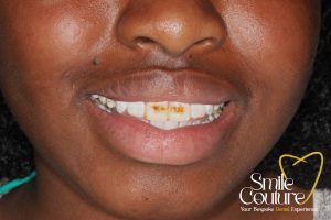 Fluorosis, Stains & Whitening