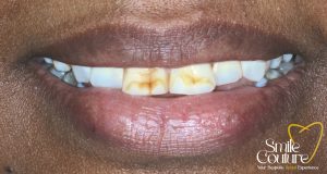 Fluorosis, Stains & Whitening