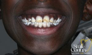 Fluorosis, Stains & Whitening