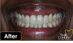 Orthodontics, Braces, Aligners