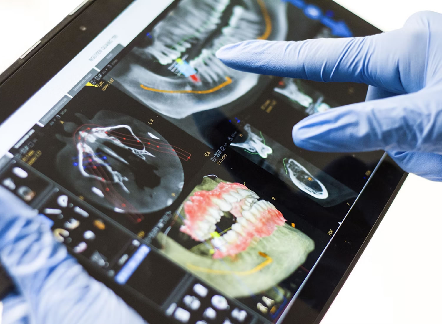 Dental Diagnostics: Xray