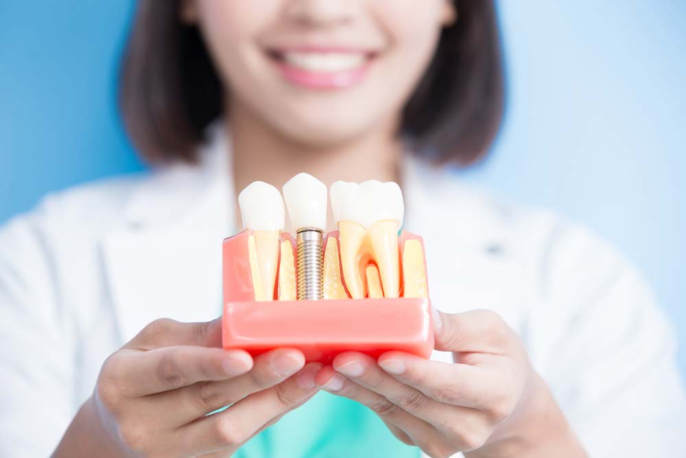 4 Myths About Dental Implants Debunked