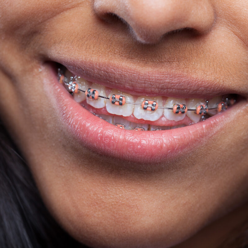 Orthodontics Braces