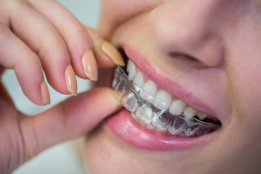 Orthodontics Aligners