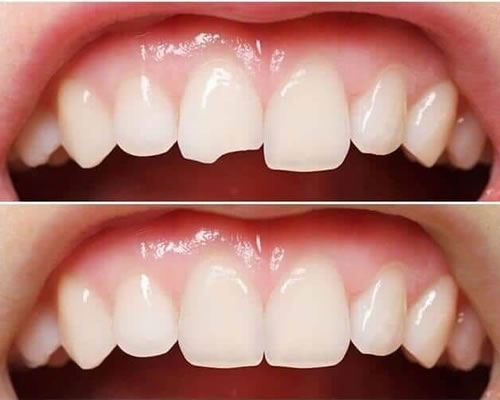 Cosmetic Dental Treatment: Dental Bonding