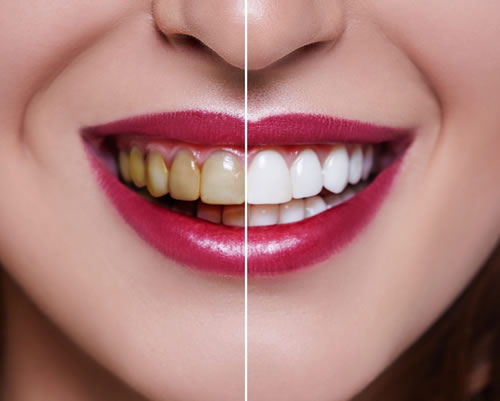 Cosmetic Dental Treatment: Veneers