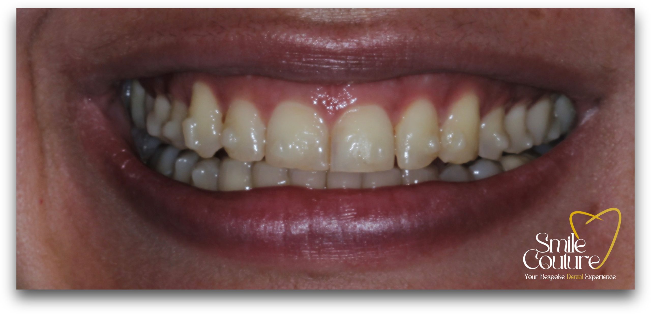Zoom Whitening Before and After