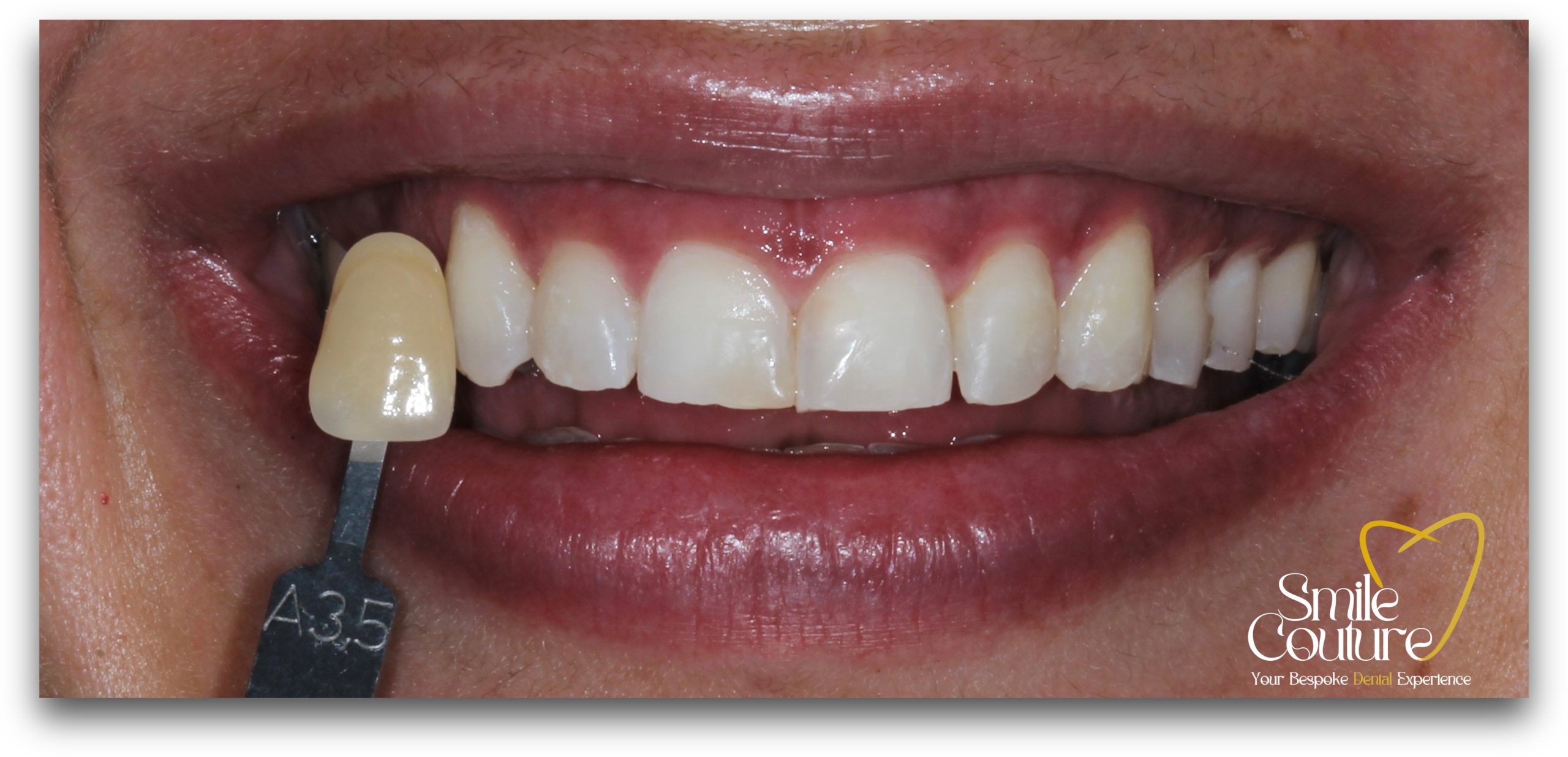 Zoom Whitening Before and After