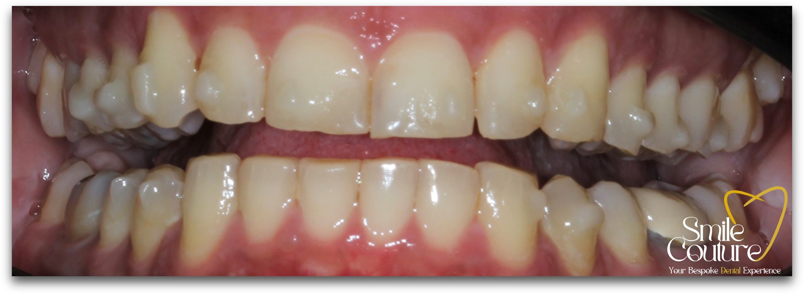 Zoom Whitening Before and After