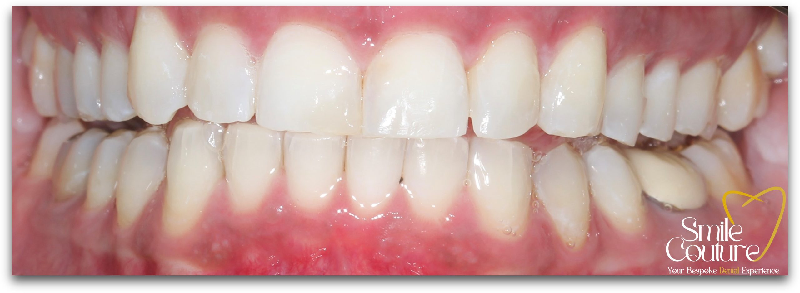 Zoom Whitening Before and After
