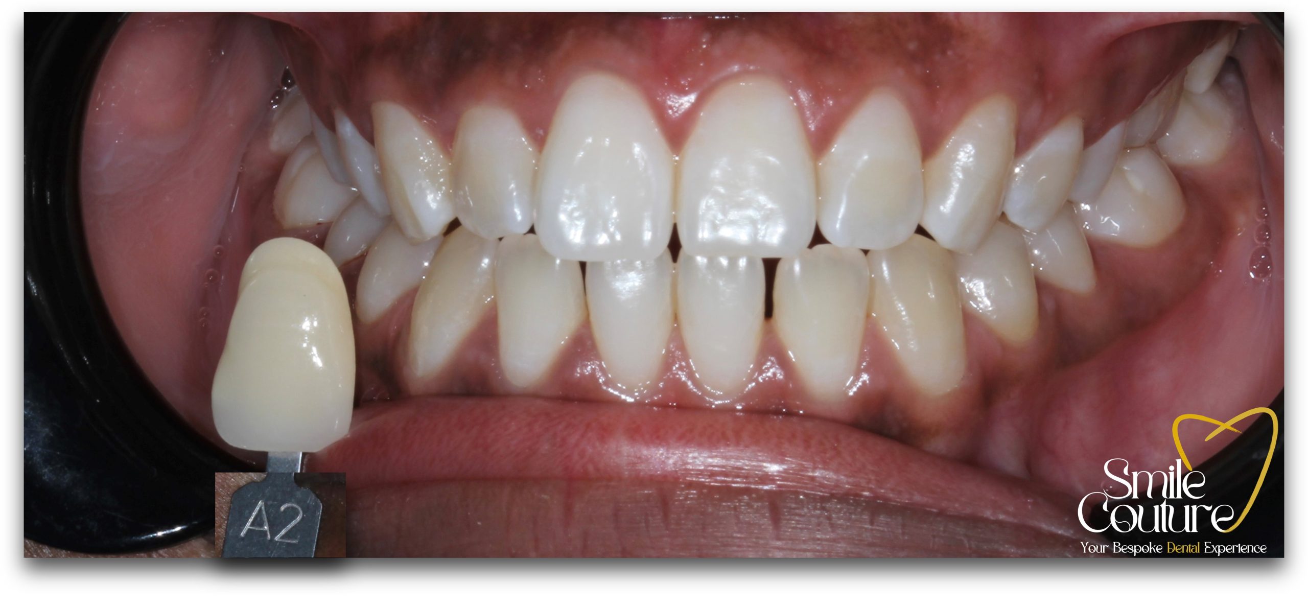Zoom Whitening Before and After