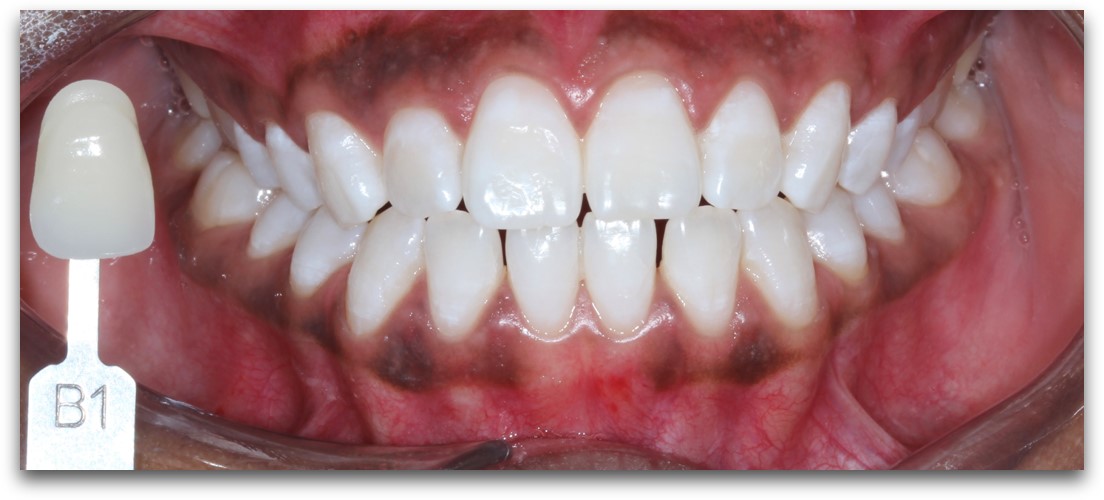 Zoom Whitening Before and After