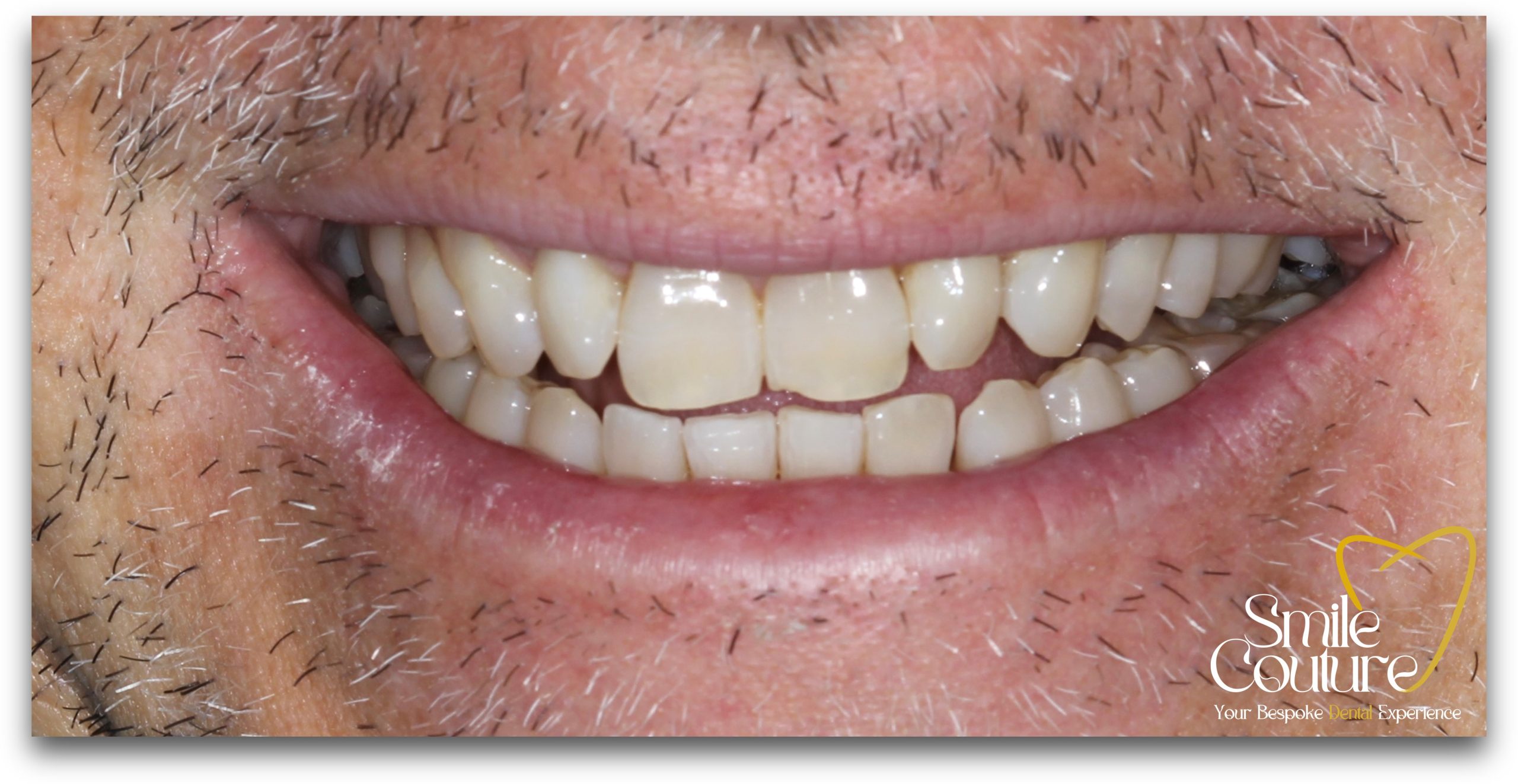 Zoom Whitening Before and After