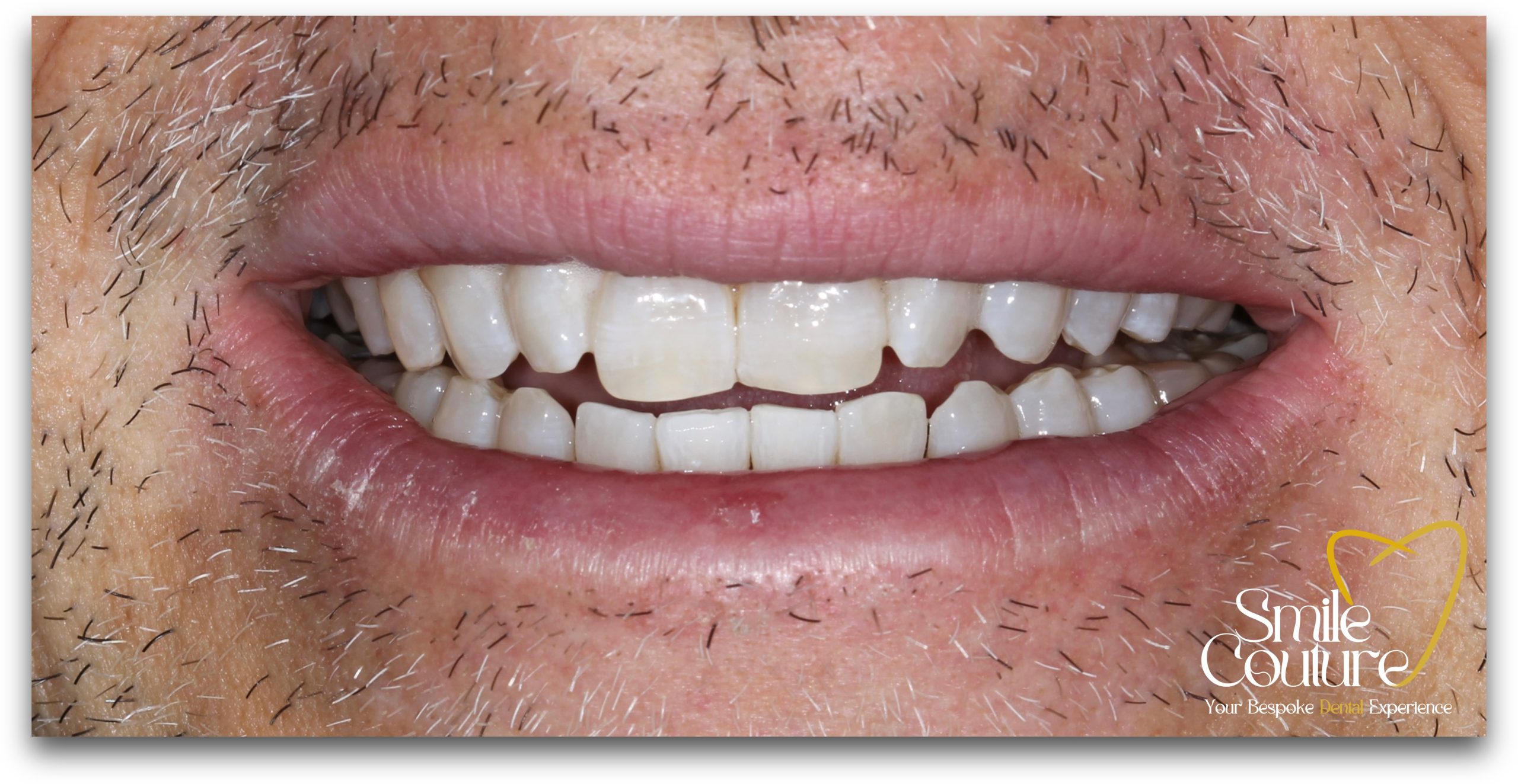 Zoom Whitening Before and After