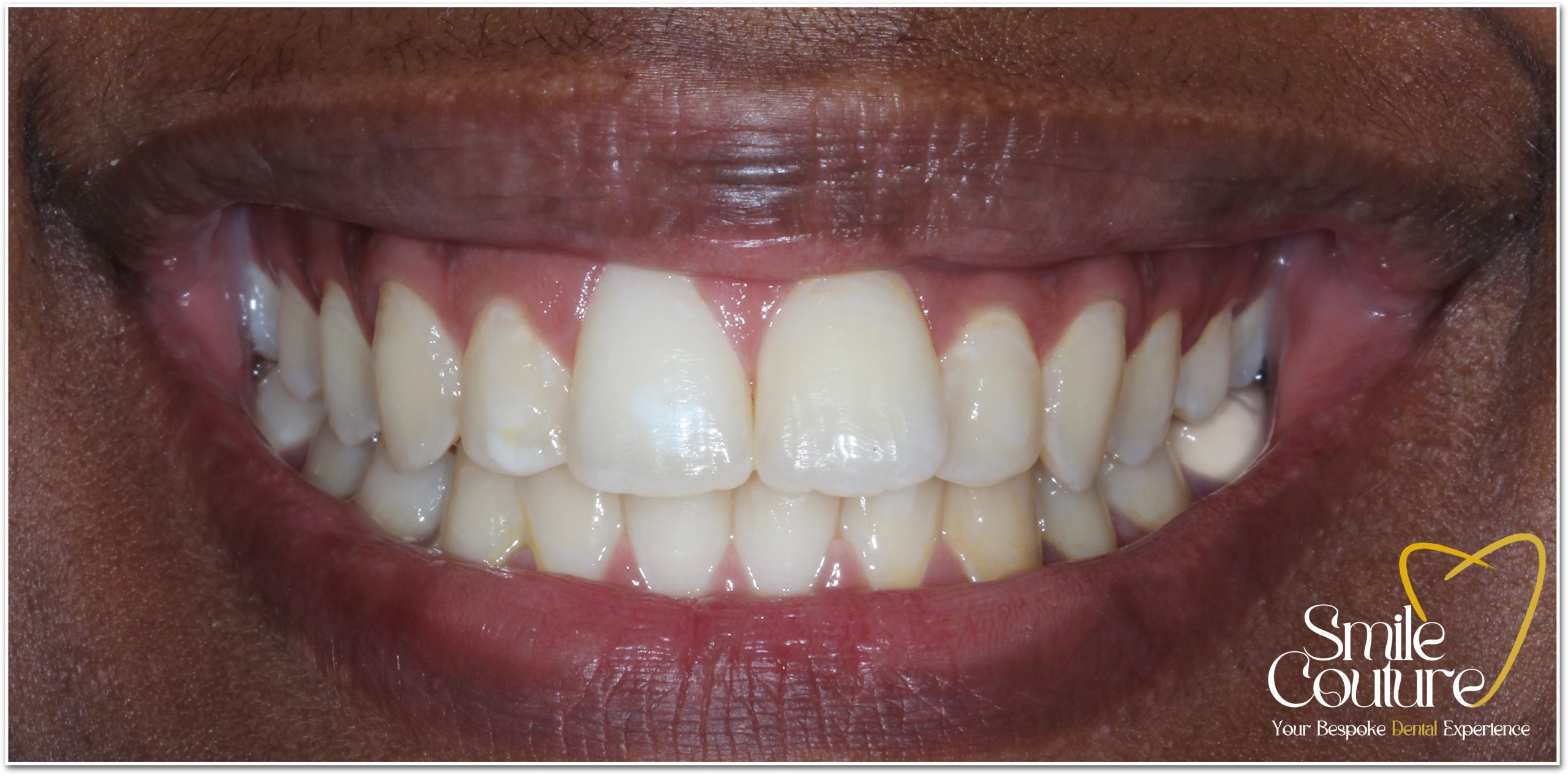 Zoom Whitening Before and After