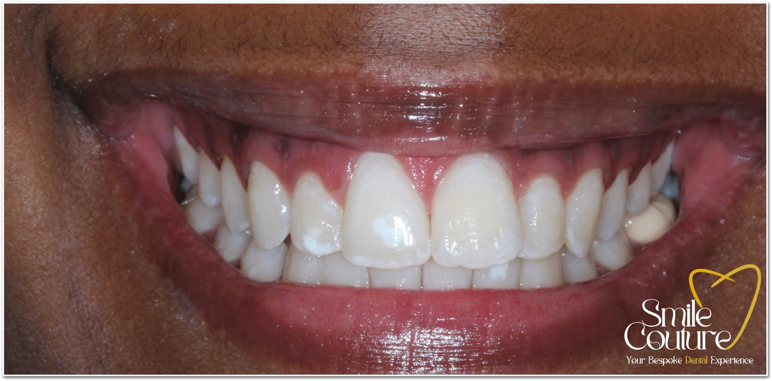 Zoom Whitening Before and After