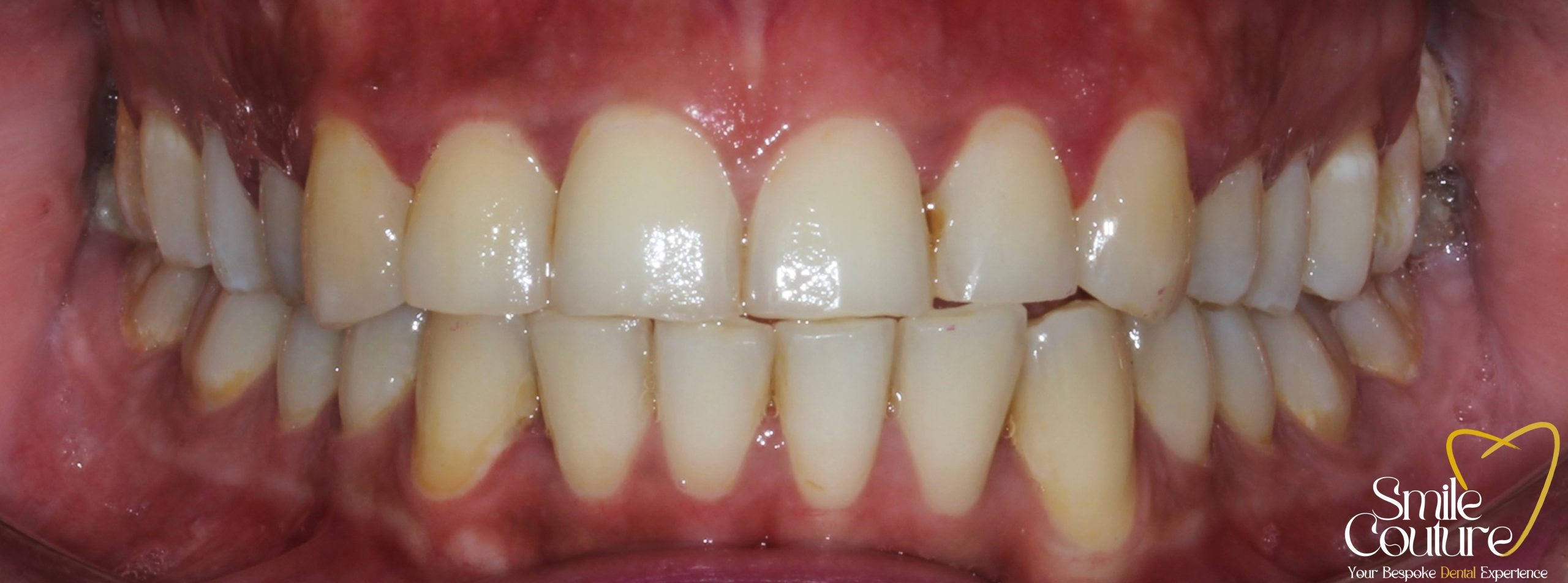 Zoom Whitening Before and After