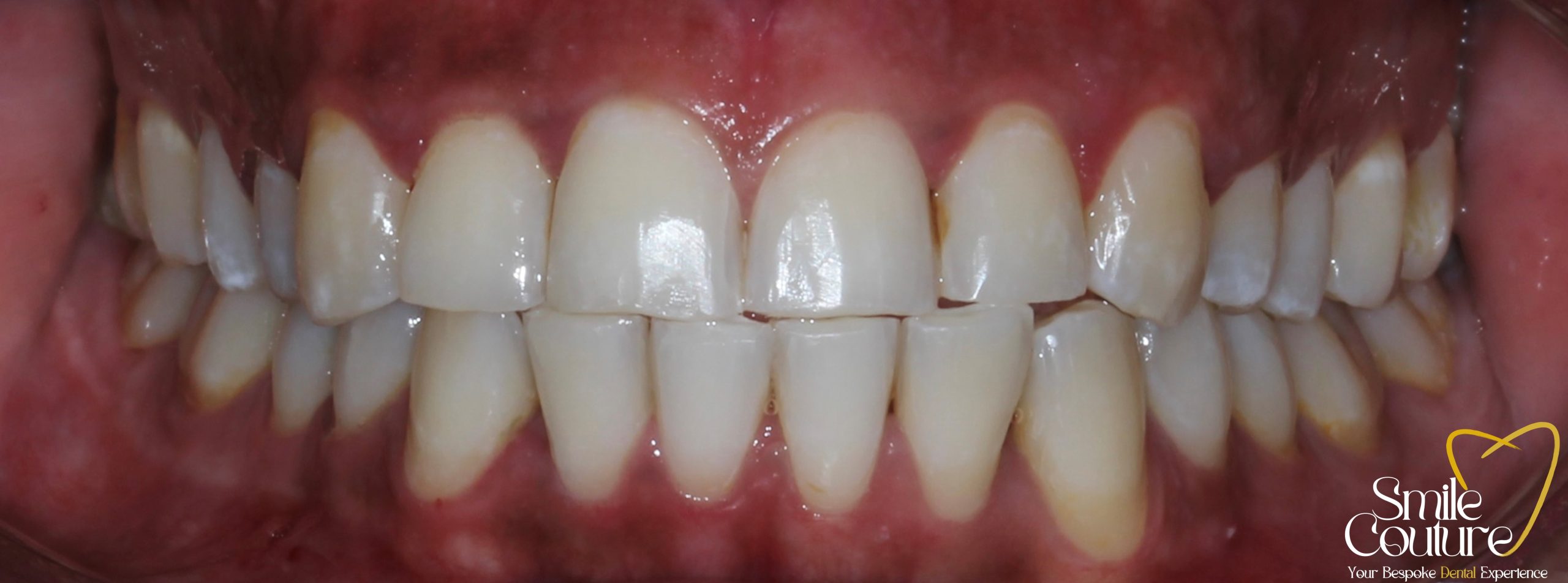 Zoom Whitening Before and After