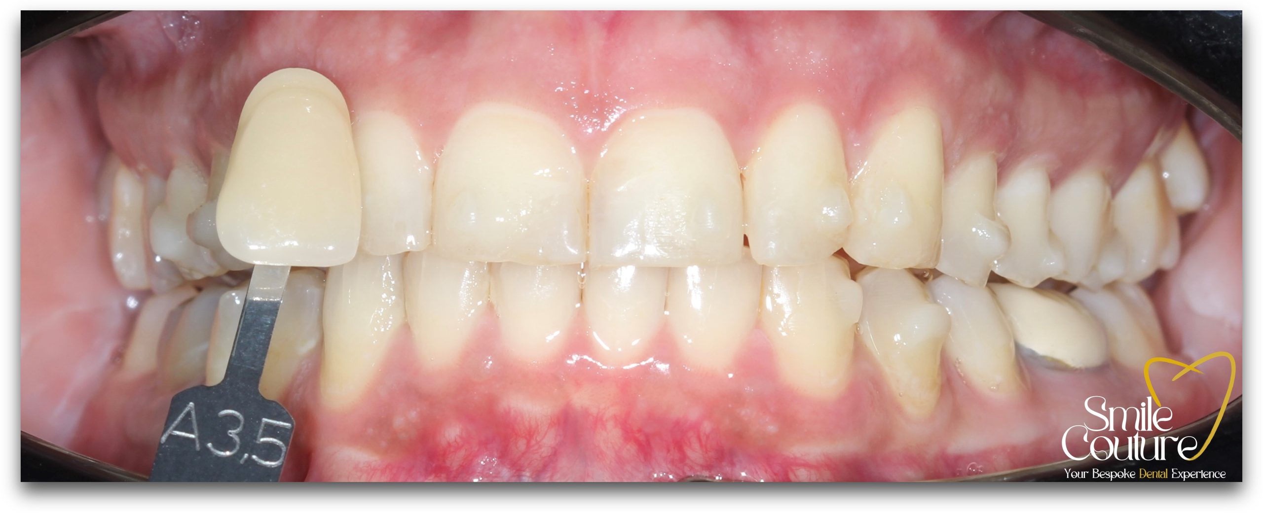 Zoom Whitening Before and After