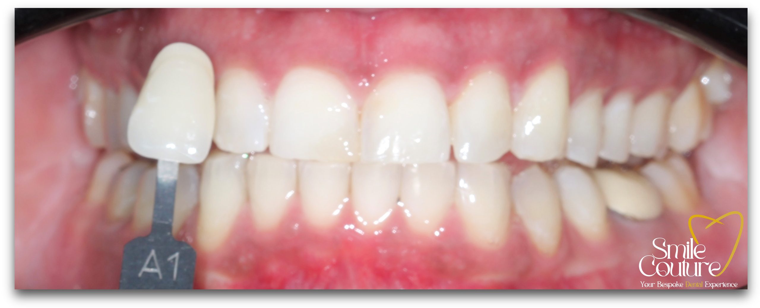 Zoom Whitening Before and After