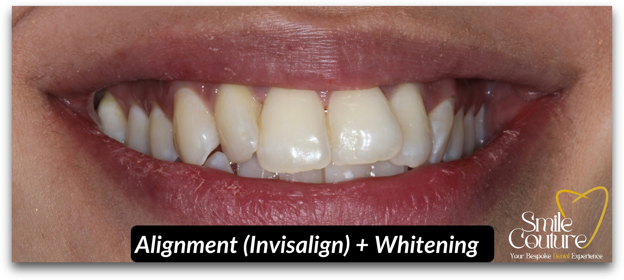 Braces, Invisalign Alignment and Zoom Whitening