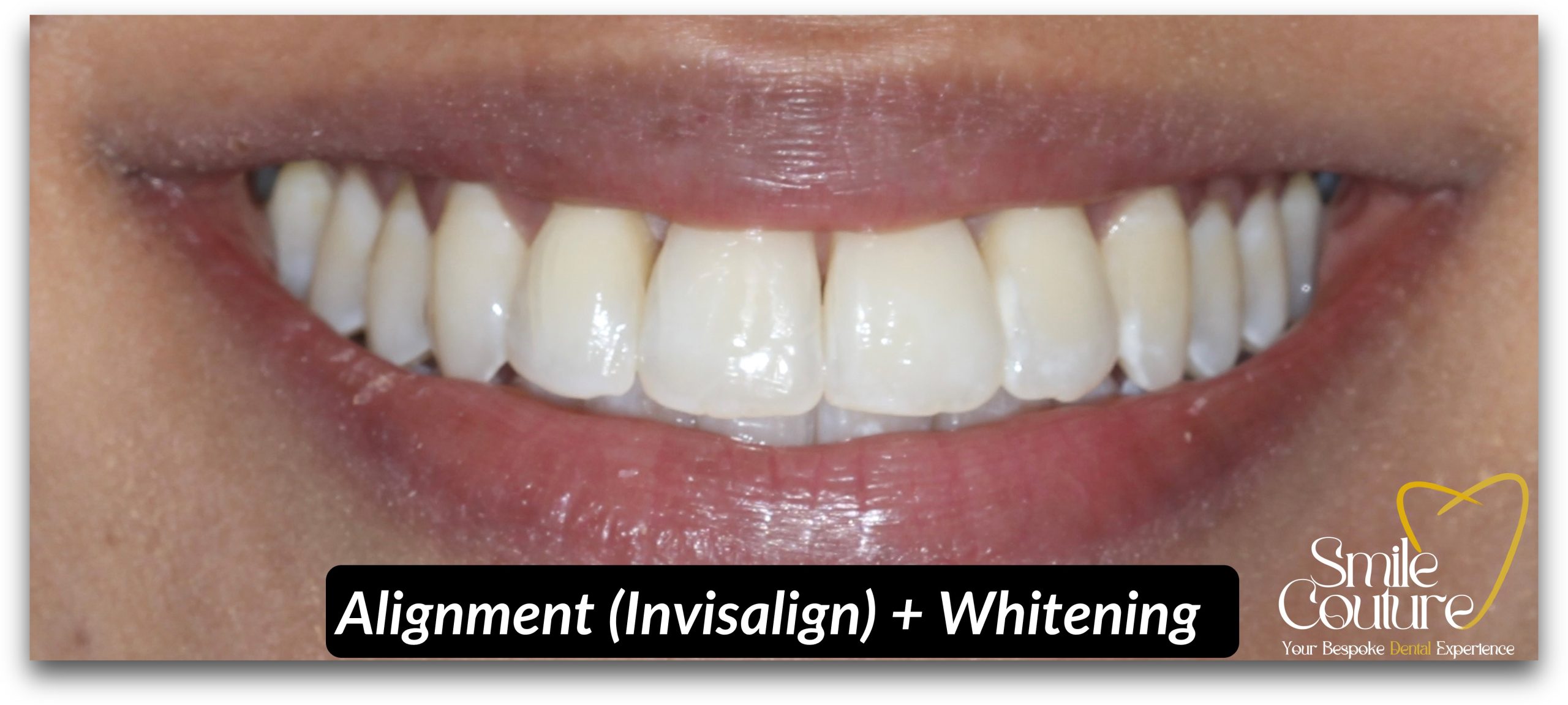 Braces, Invisalign Alignment and Zoom Whitening