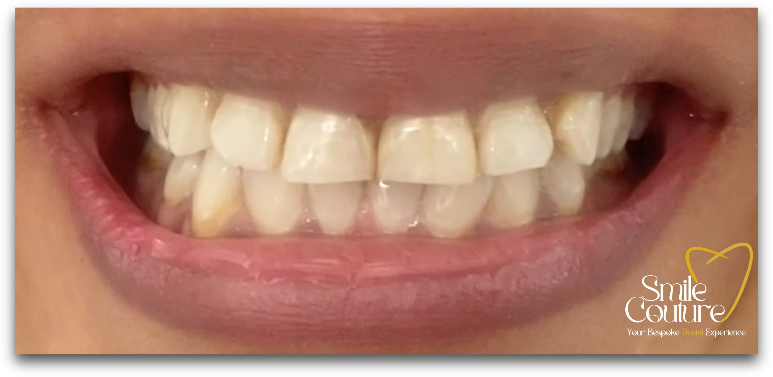 Zoom Whitening Before and After
