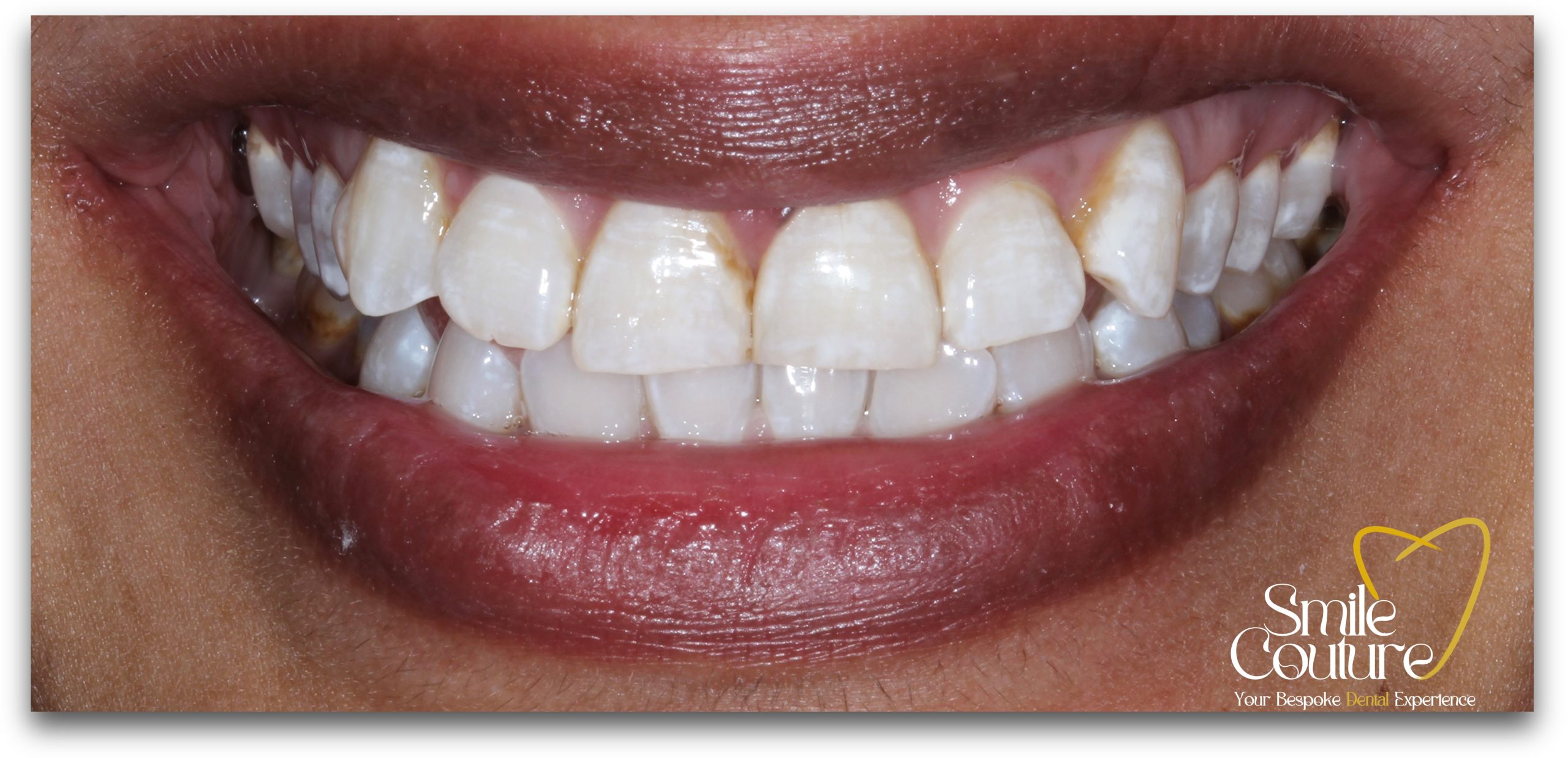 Zoom Whitening Before and After