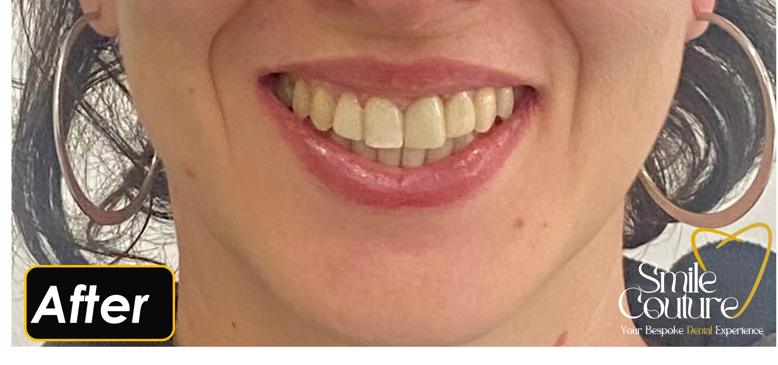 Smile Makeover