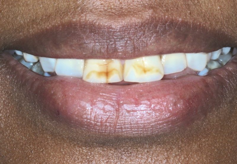 Fluorosis, Masking & Whitening