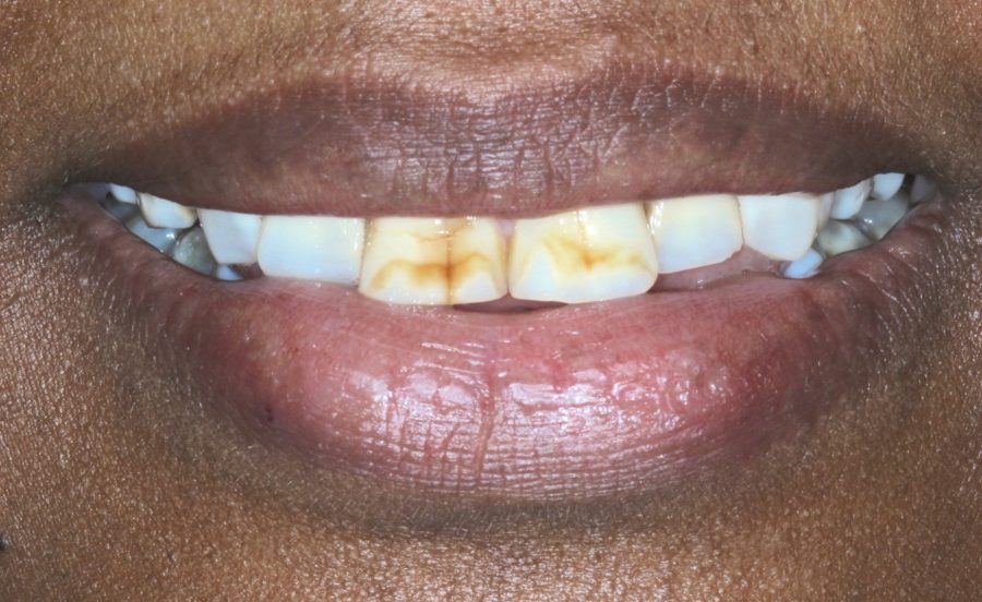 Fluorosis, Masking & Whitening