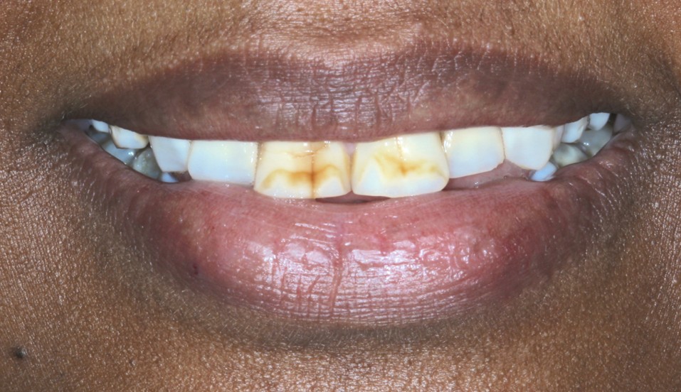 Stains, Fluorosis and Whitening (without Masking)
