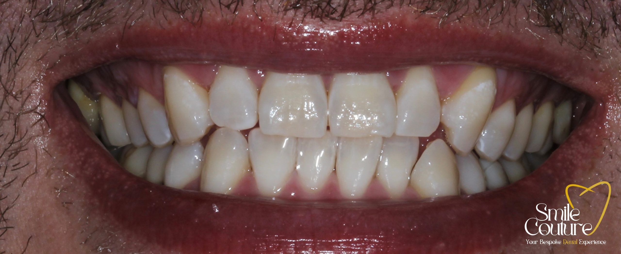 1 HOUR POWER WHITENING
