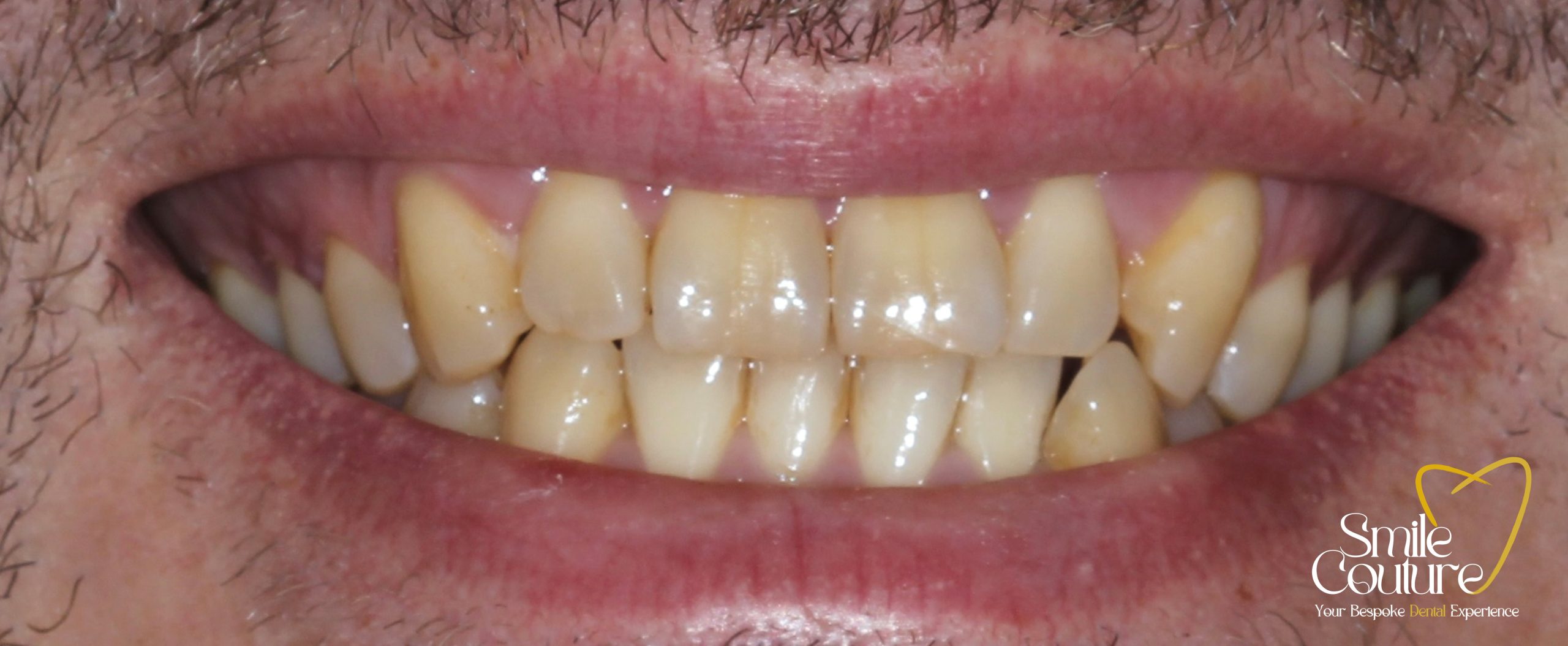 1 HOUR POWER WHITENING